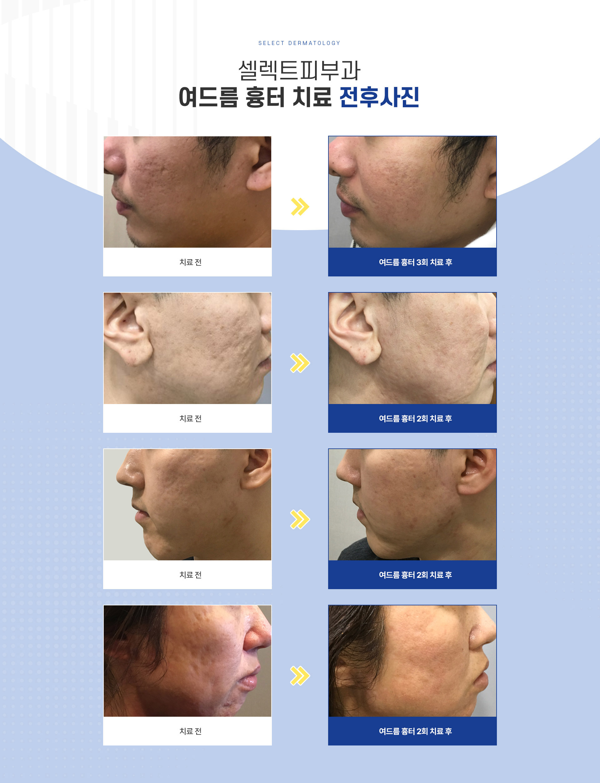 여드름흉터 전후사진