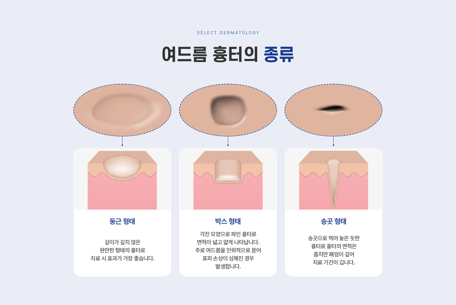 여드름흉터 종류