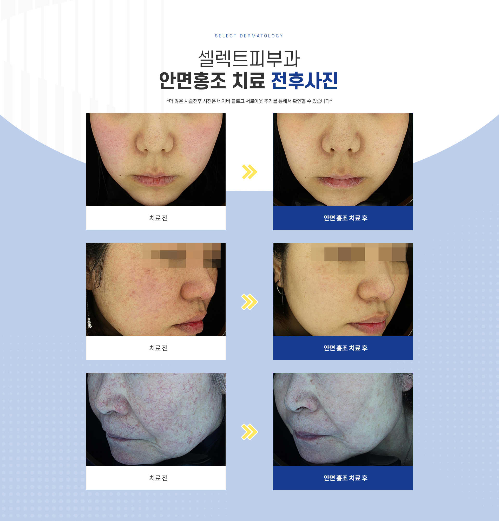 안면홍조딸기코 종류