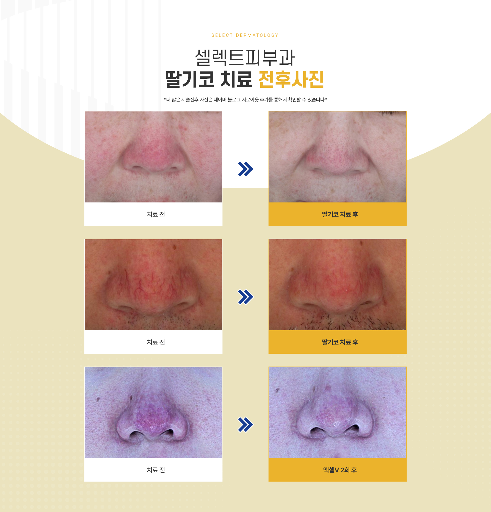 안면홍조딸기코 치료방법