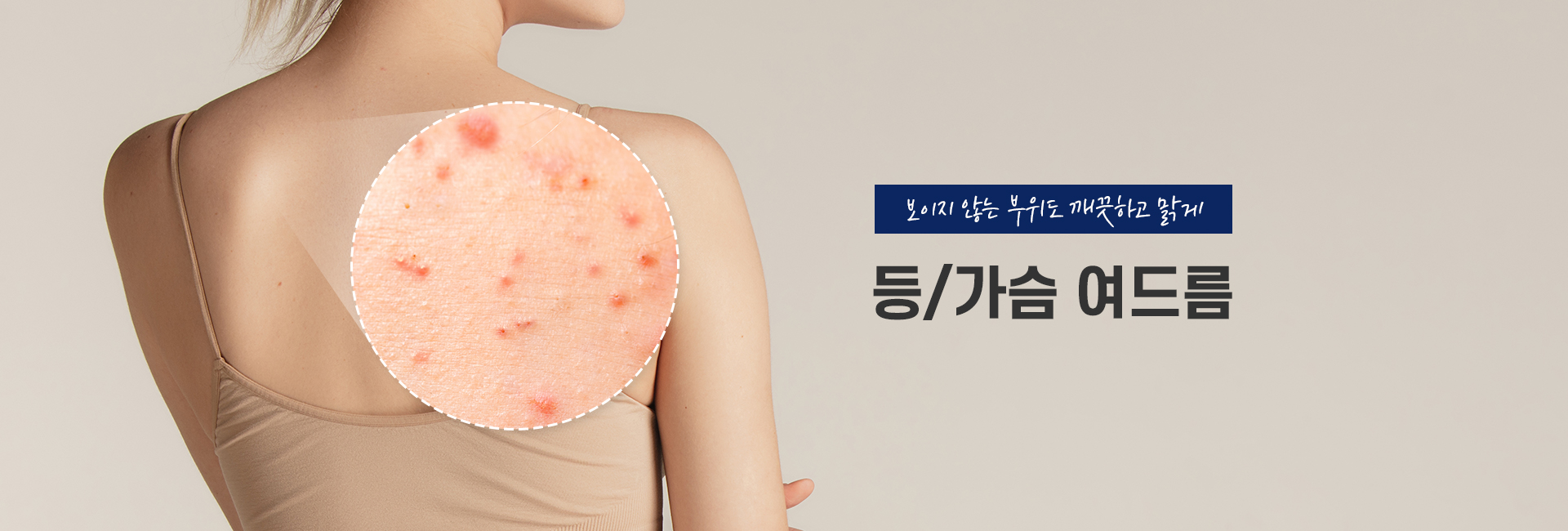 등/가슴 여드름 키비주얼
