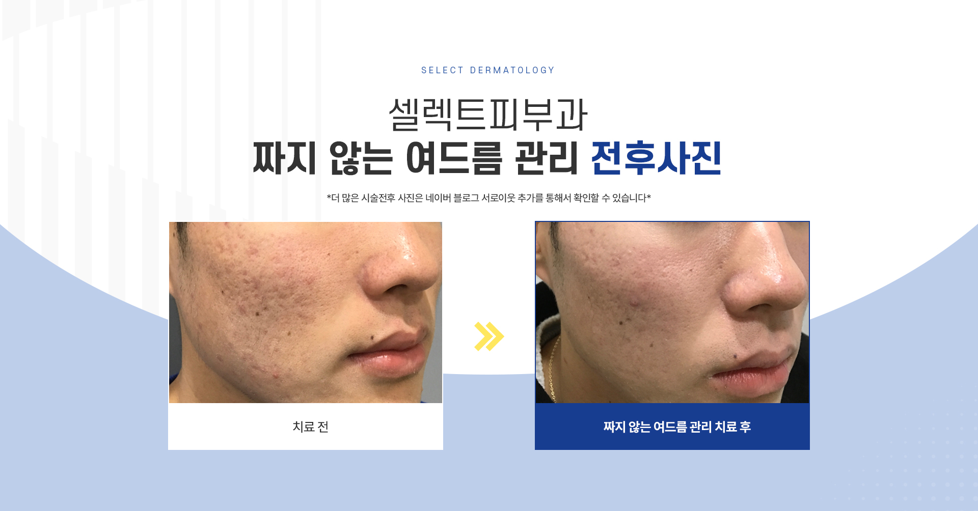 짜지않는여드름관리 전후사진