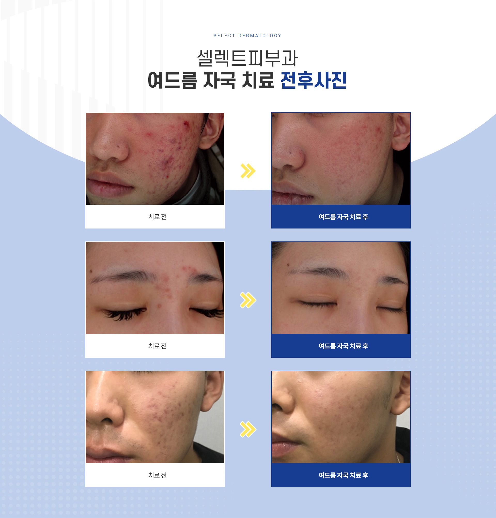 여드름자국 전후사진