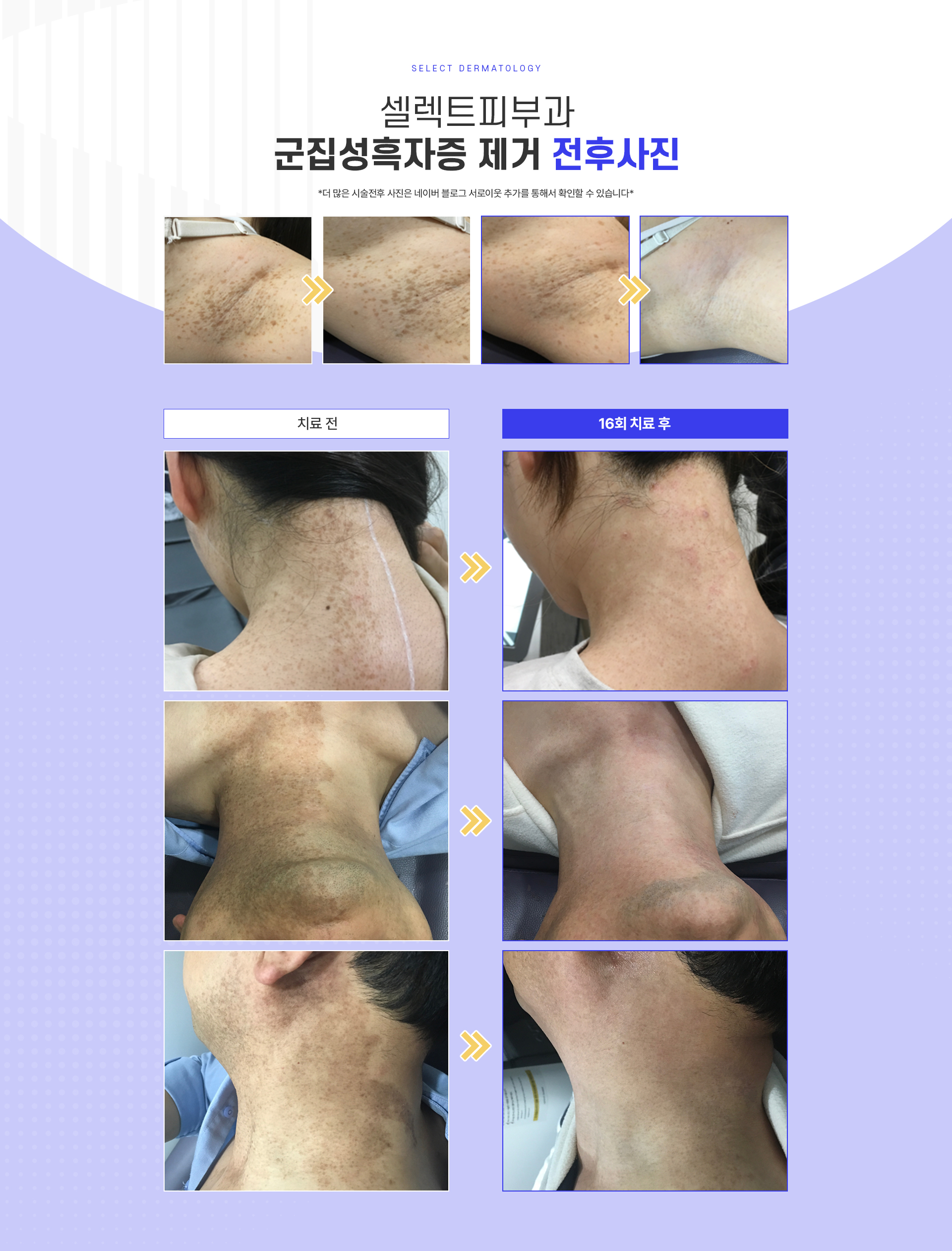 군집성흑자종 전후사진