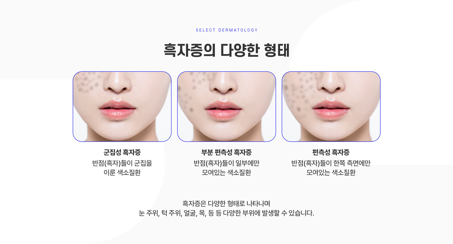 군집성흑자종 치료방법
