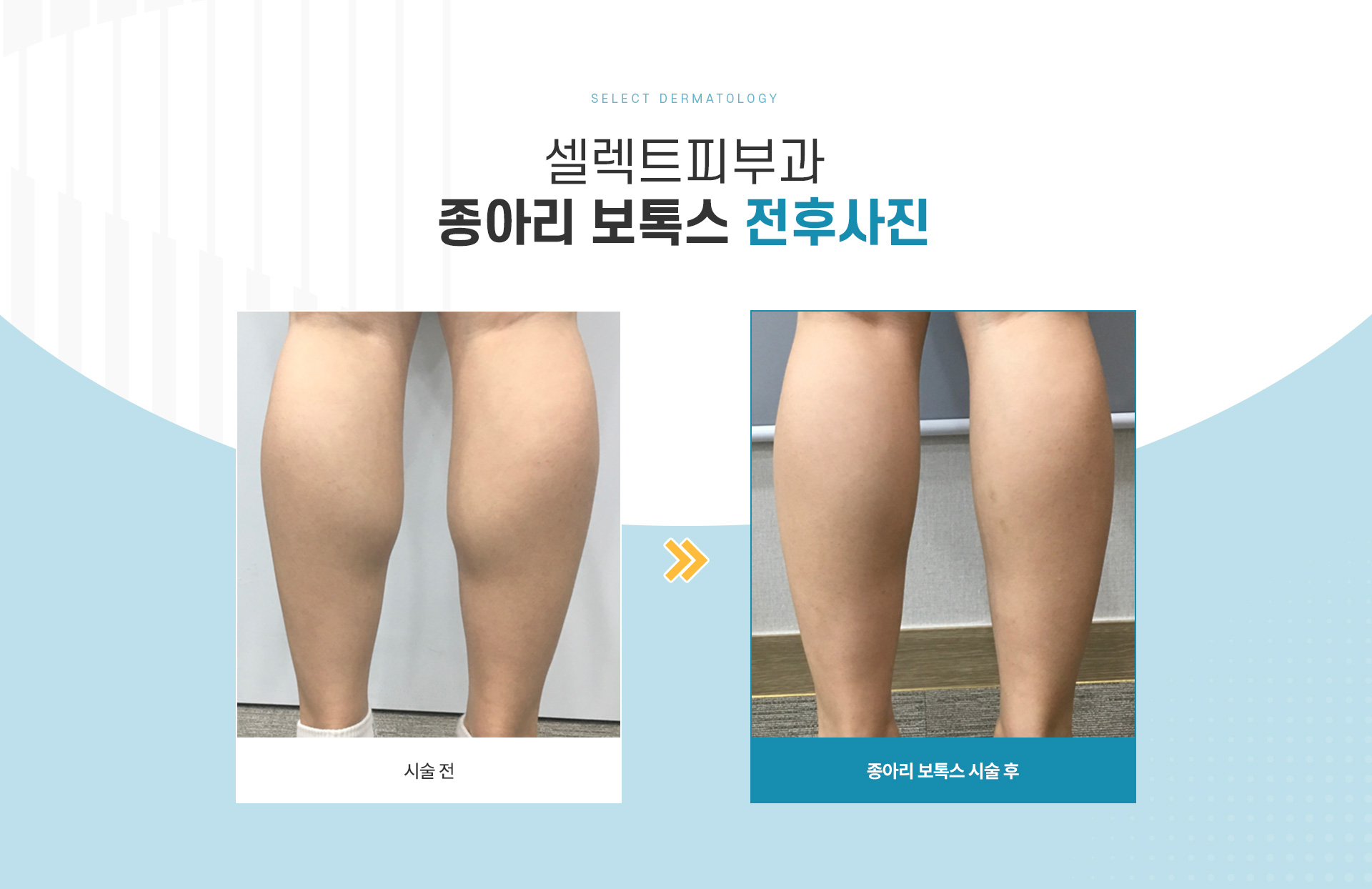 종아리보톡스 치료방법