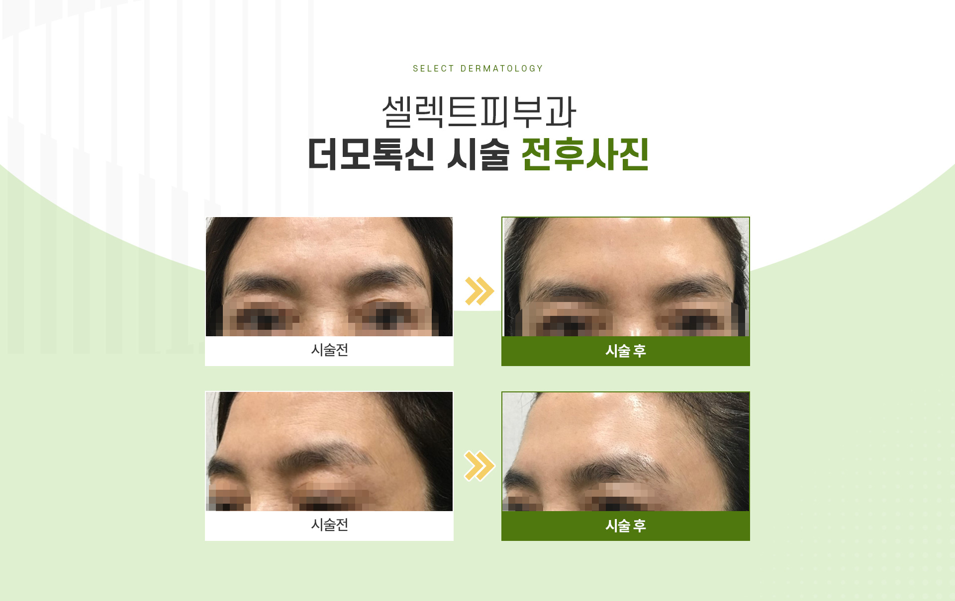 더모톡신 전후사진