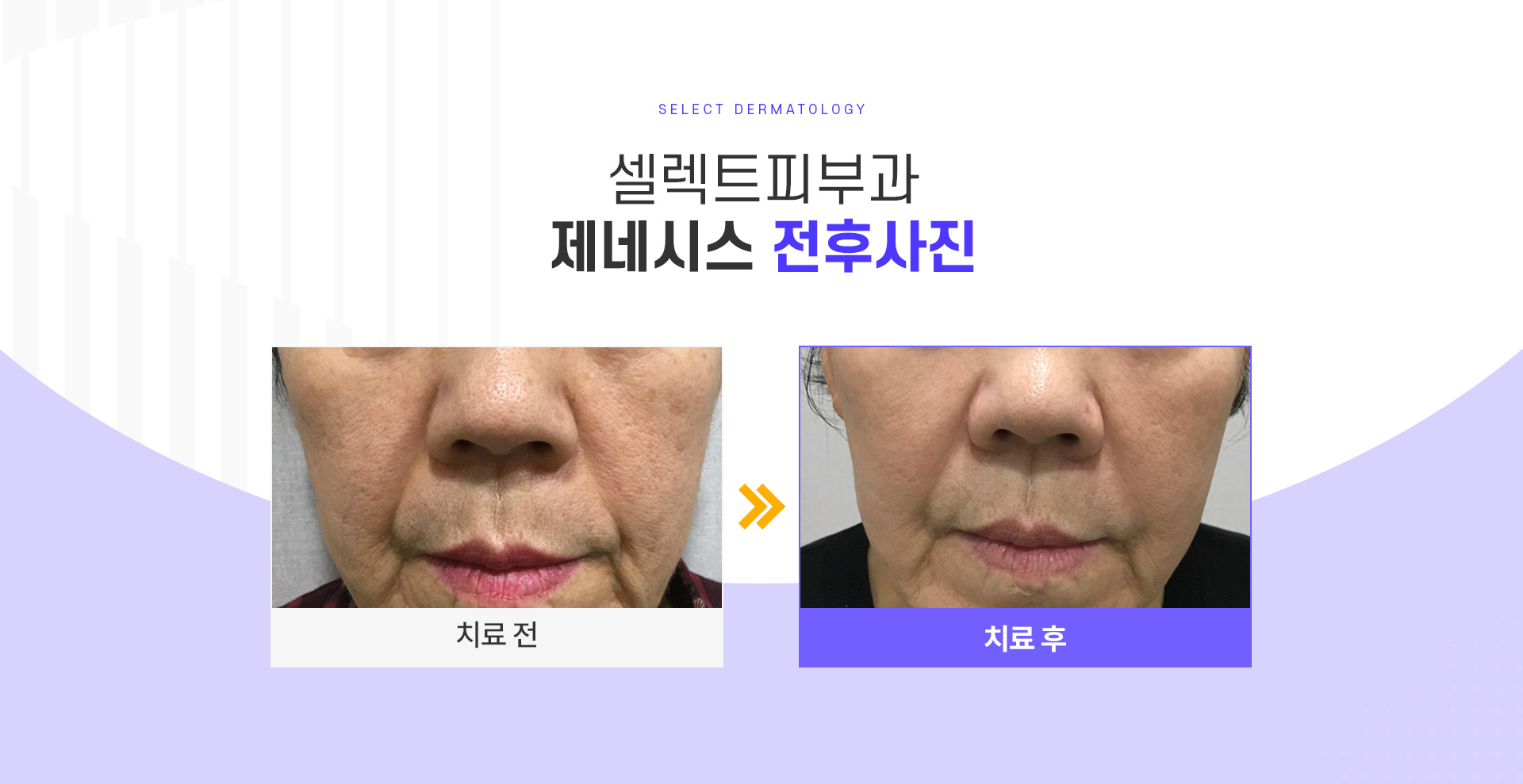 제네시스 전후사진