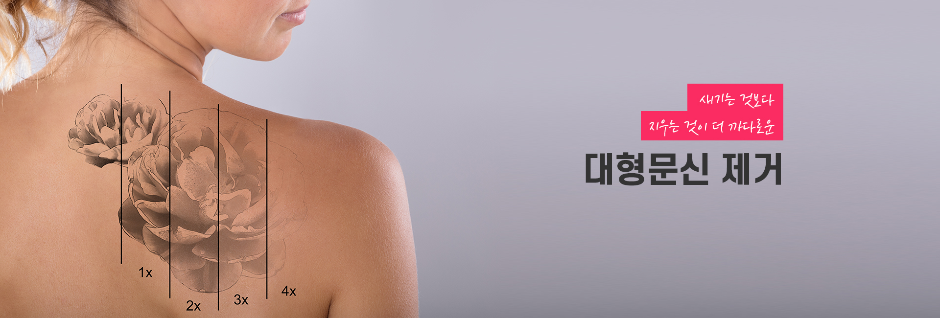 대형문신제거 키비주얼