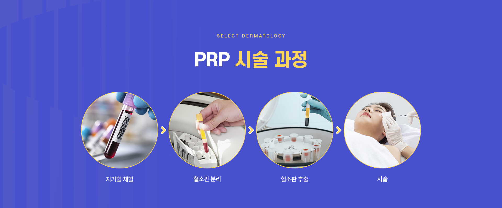 PRP 치료방법