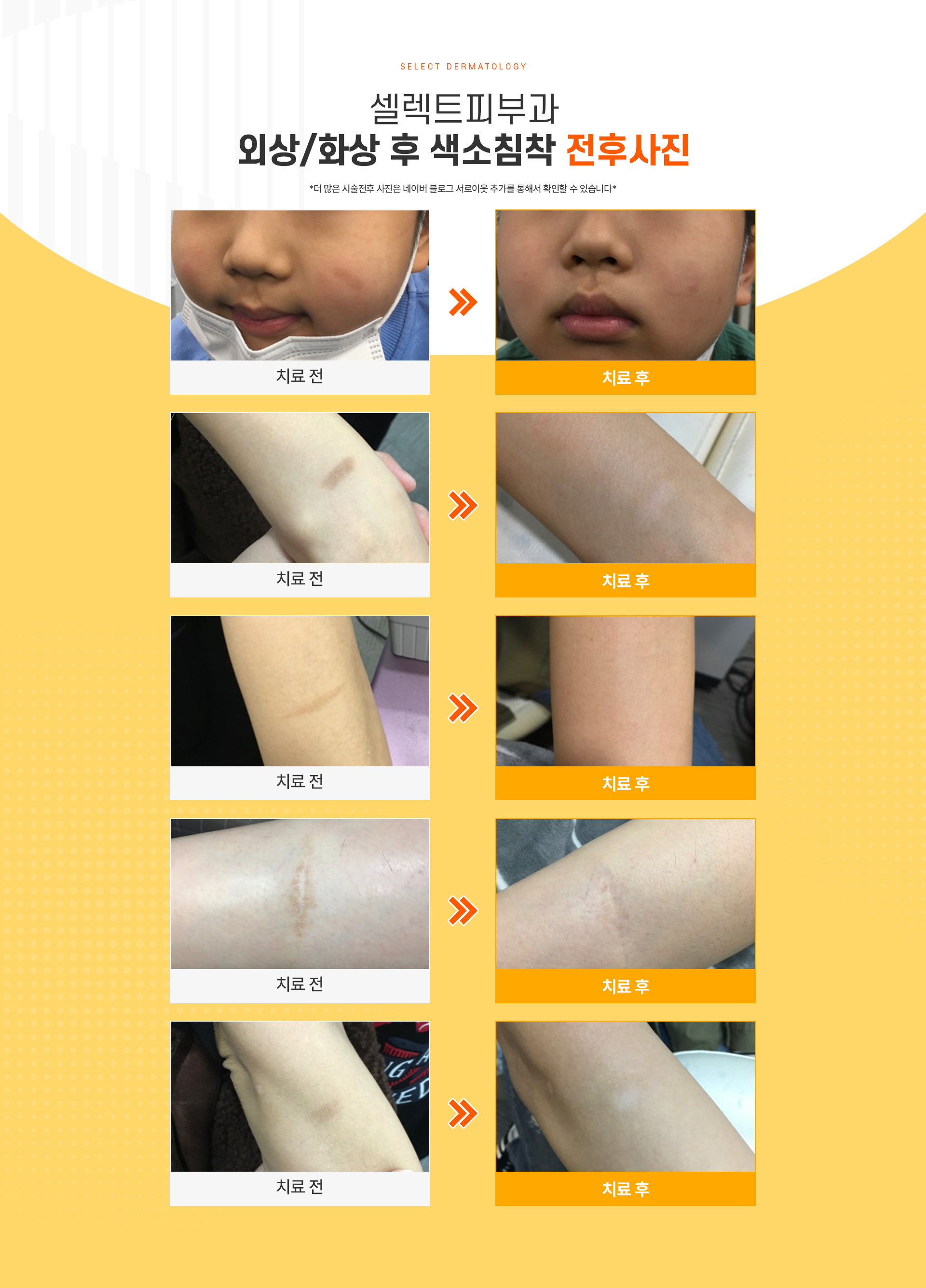 외상화상후색소침착 전후사진