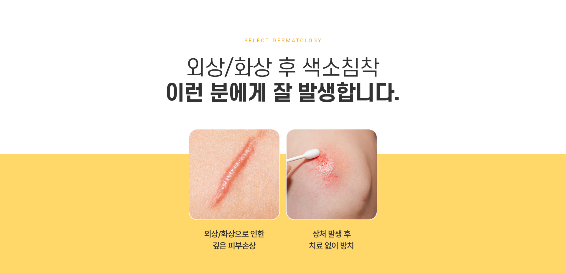 외상화상후색소침착 치료방법