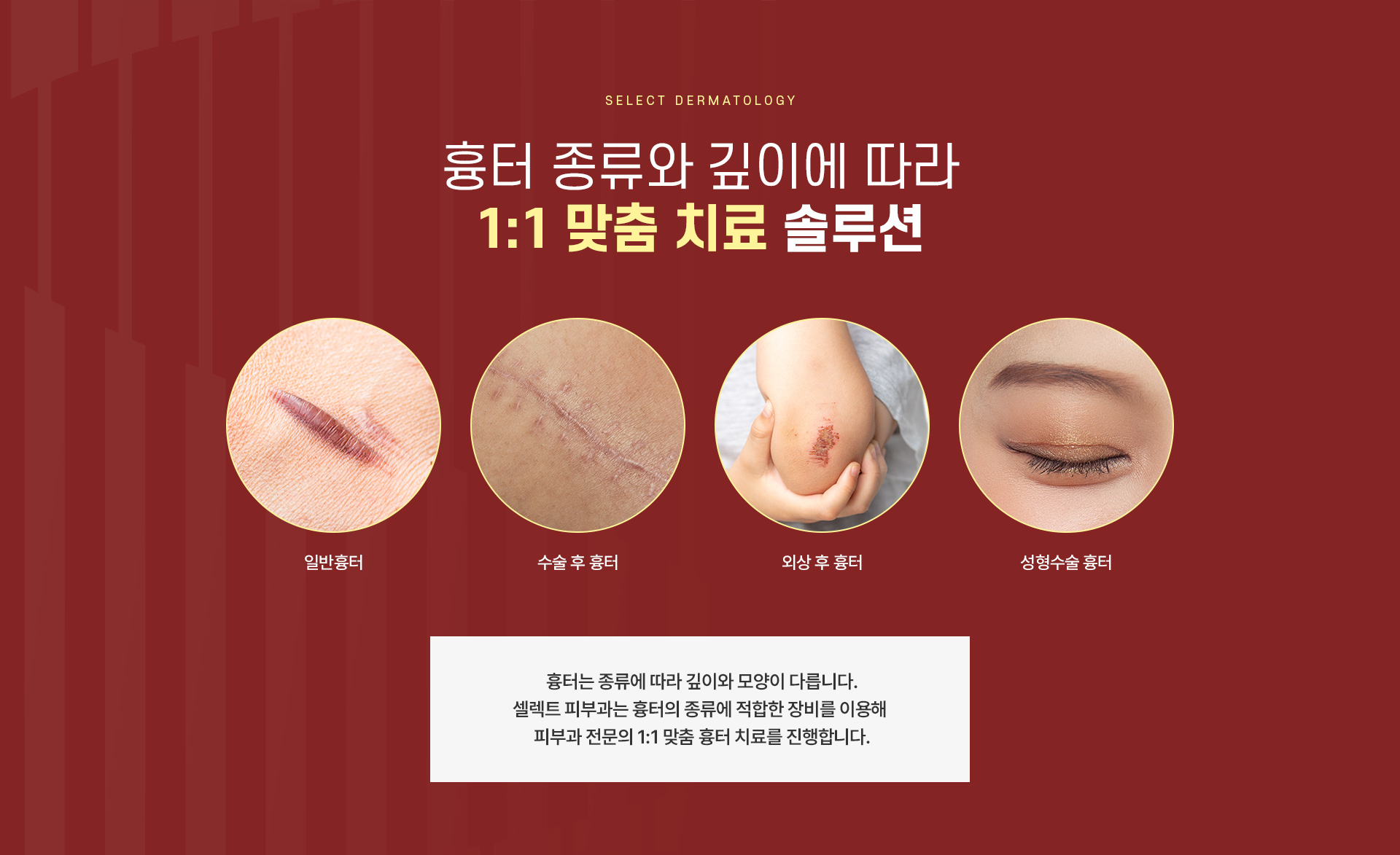 수술후외상흉터치료 가격안내