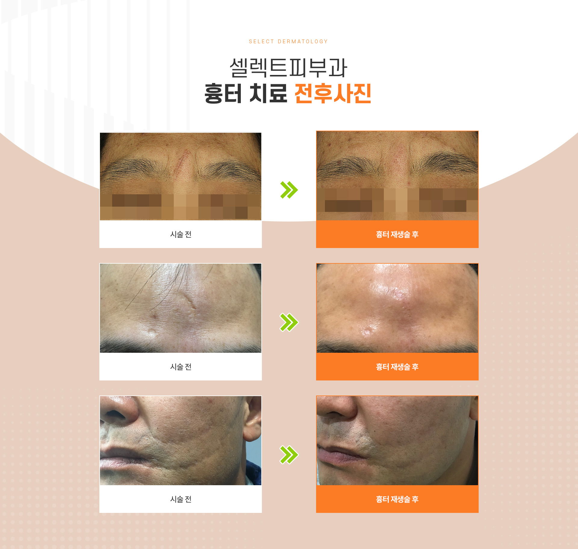 수술후외상흉터치료 전후사진