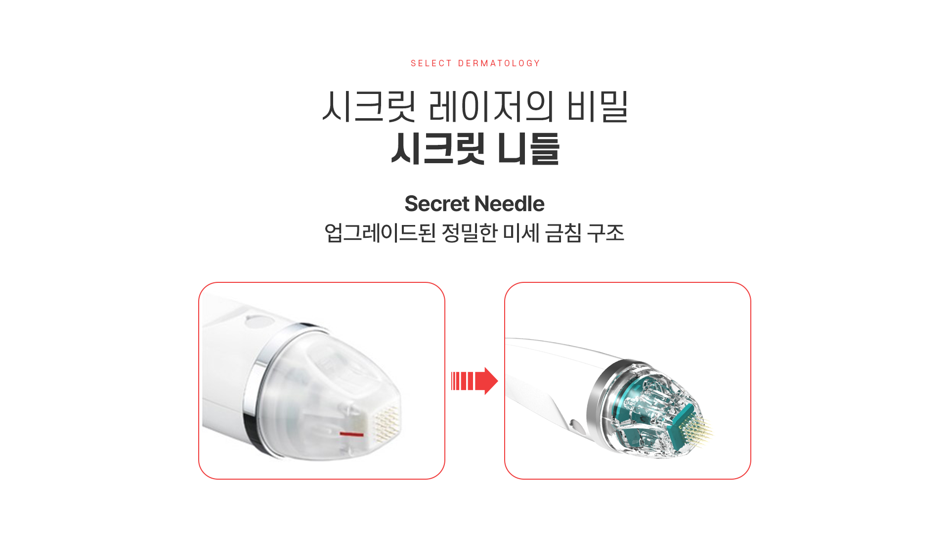시크릿레이저 치료방법
