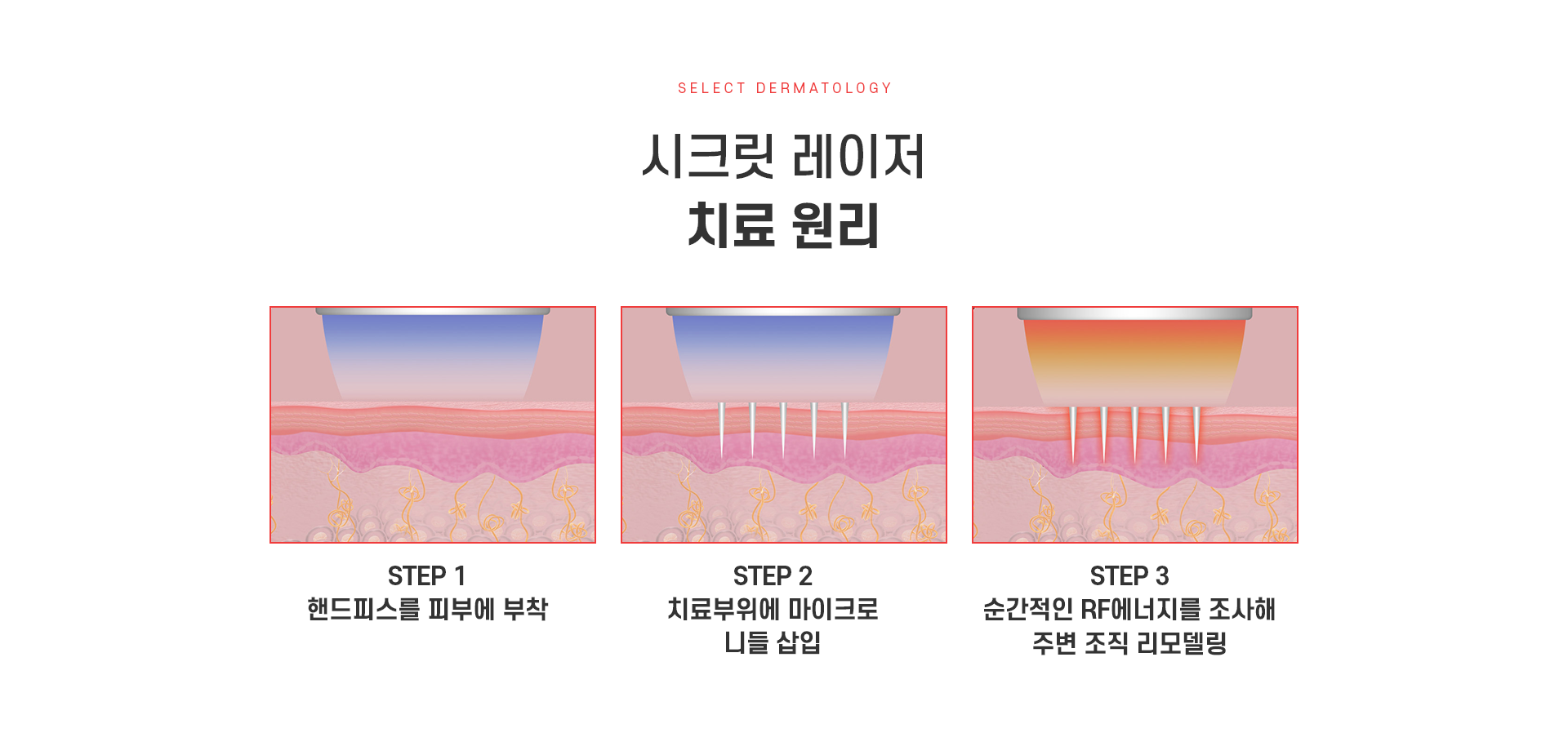 시크릿레이저 치료방법