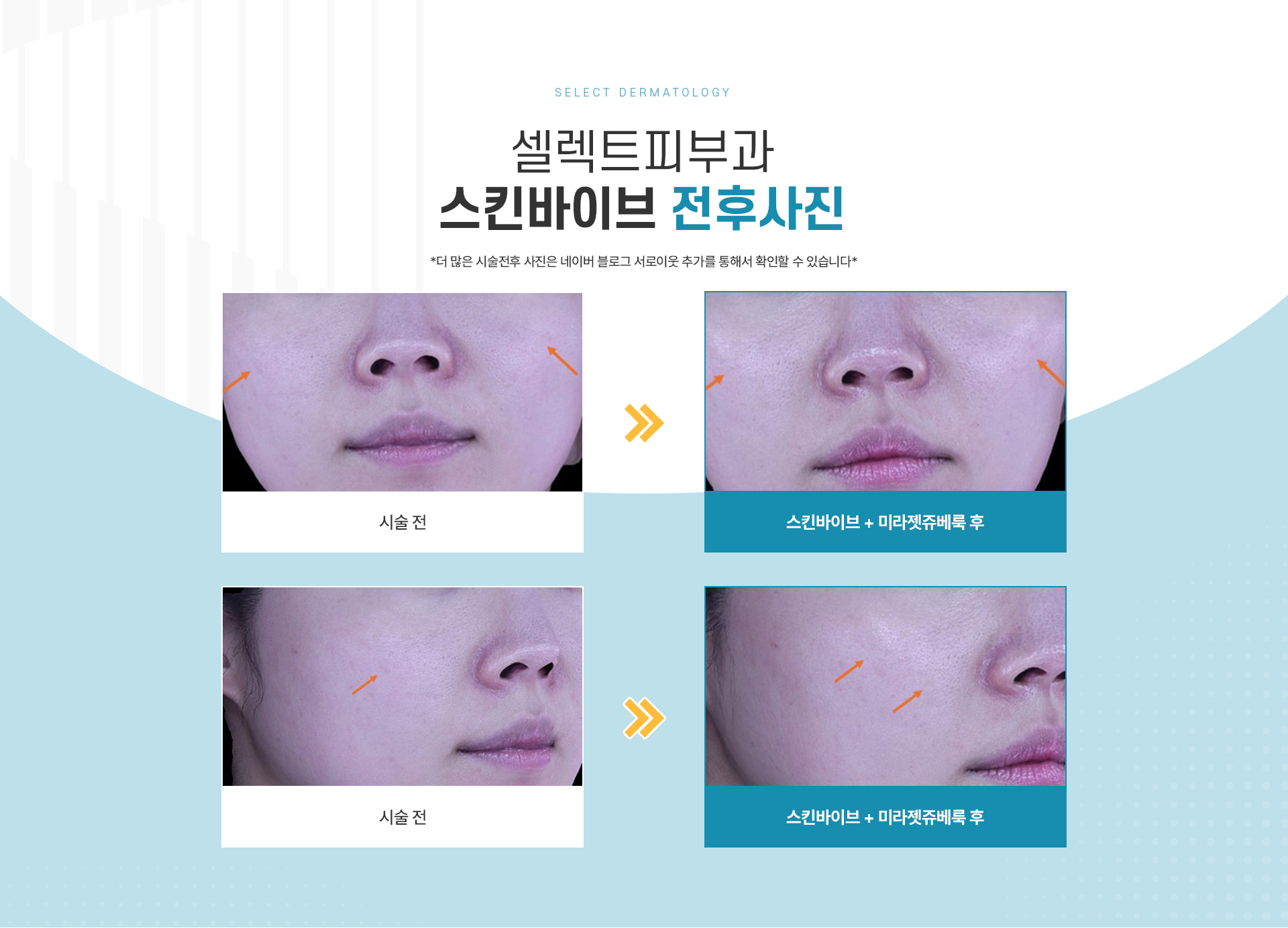 스킨바이브 전후사진