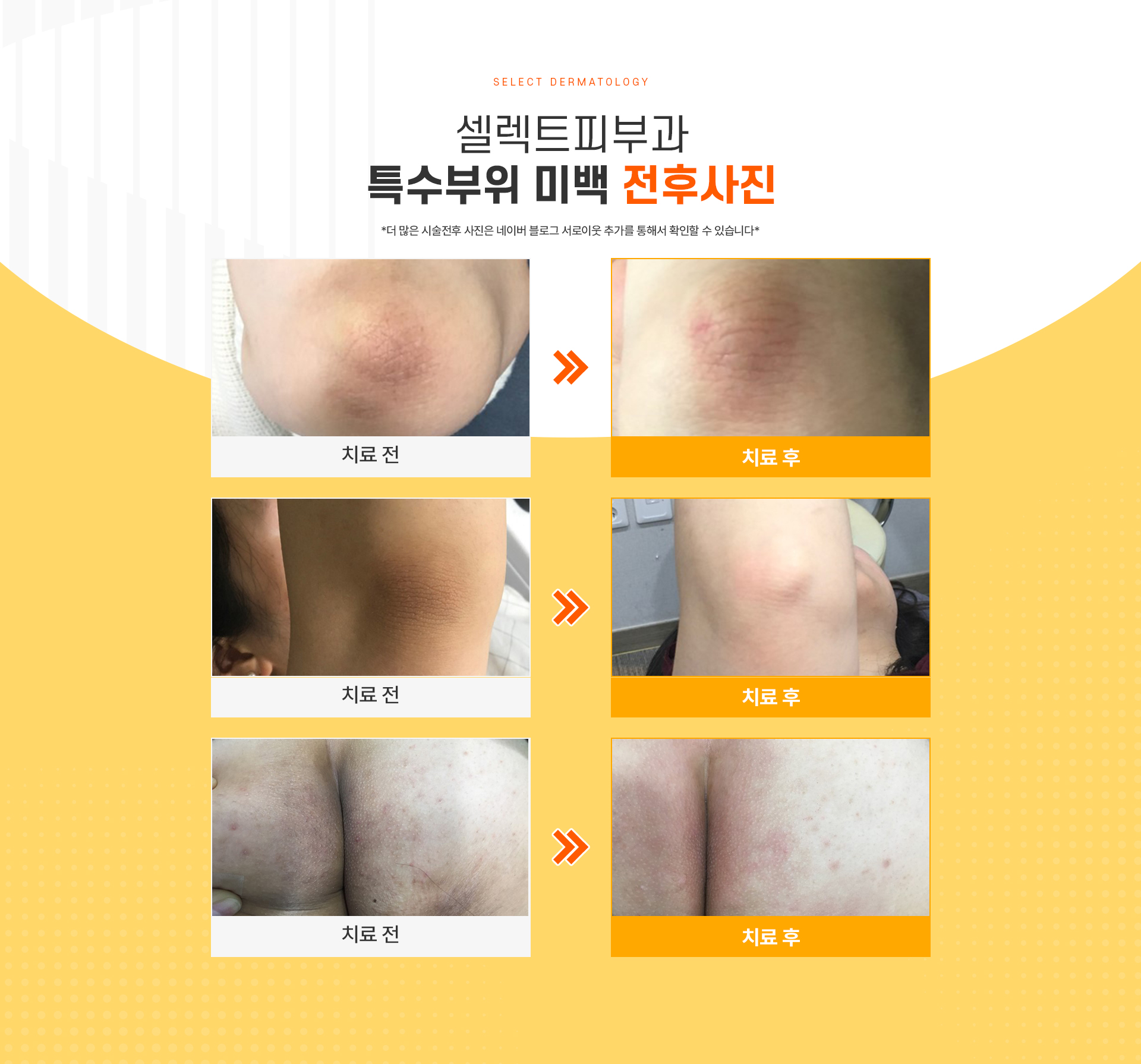 특수부위미백 전후사진