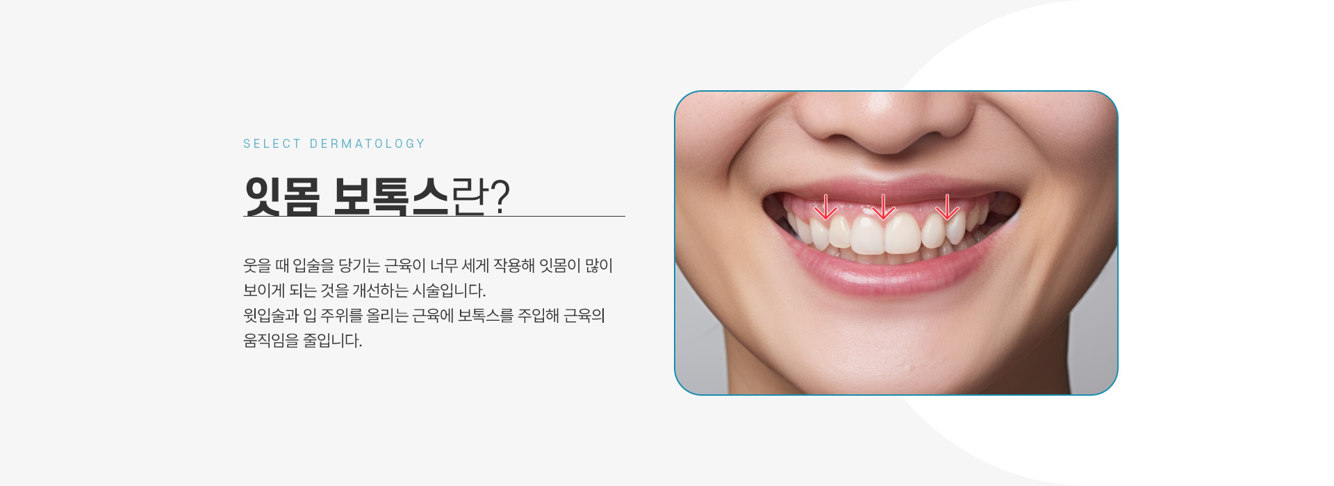 잇몸턱보톡스 전후사진