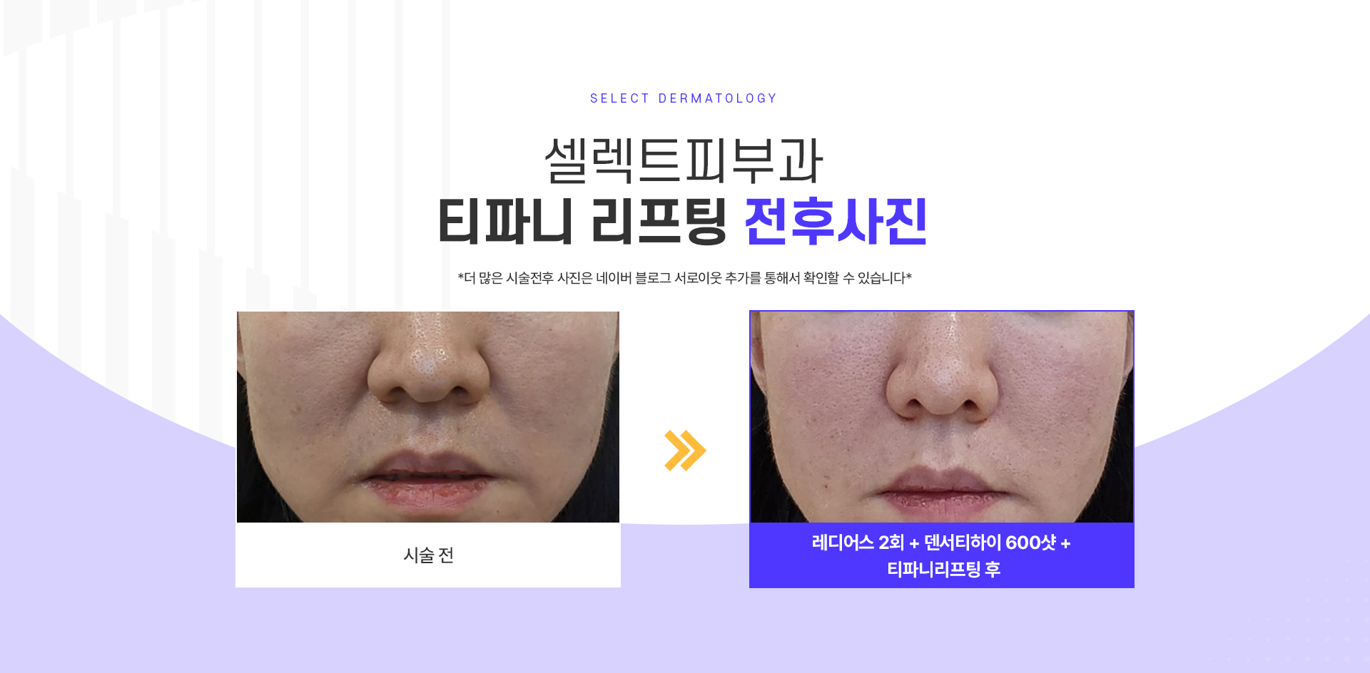 티파니리프팅 전후사진