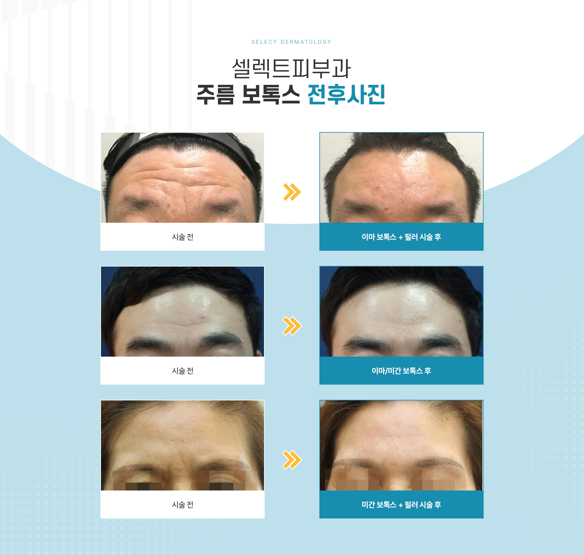 주름보톡스 전후사진