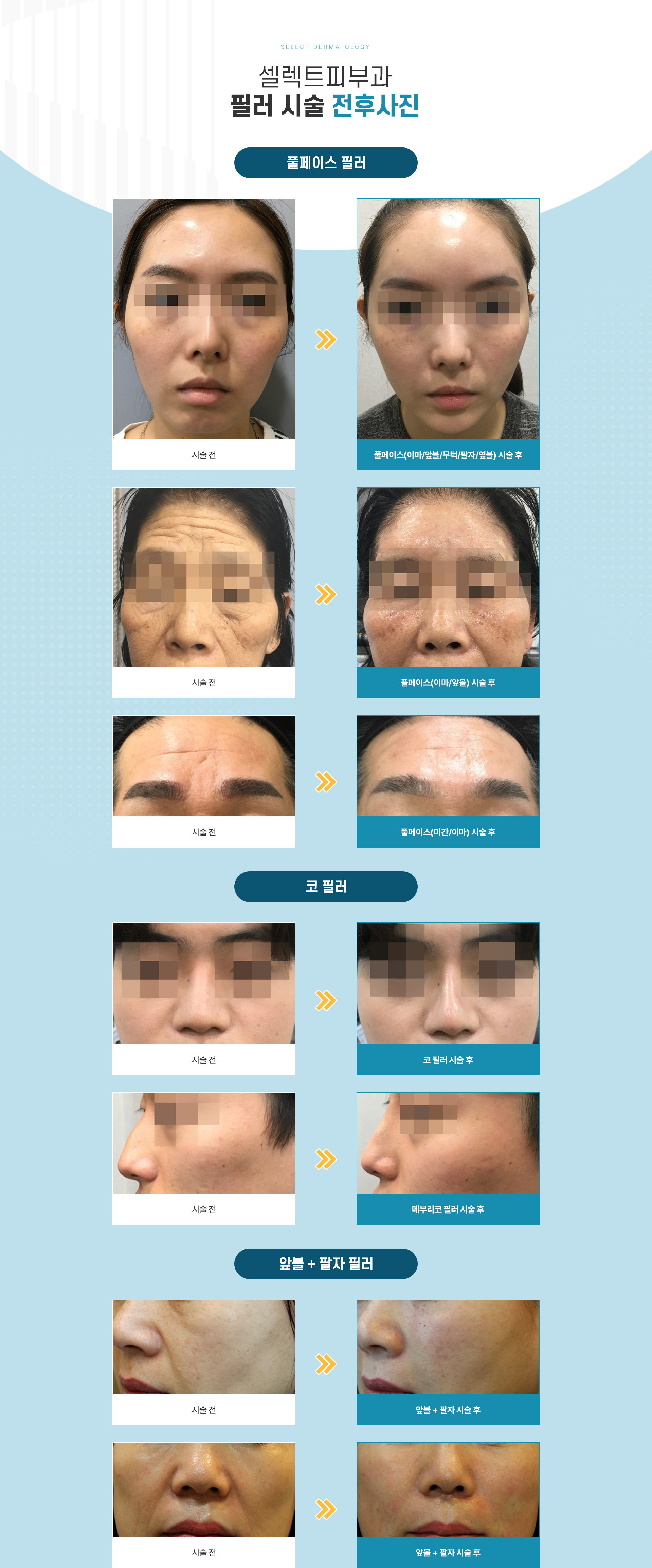 필러 전후사진