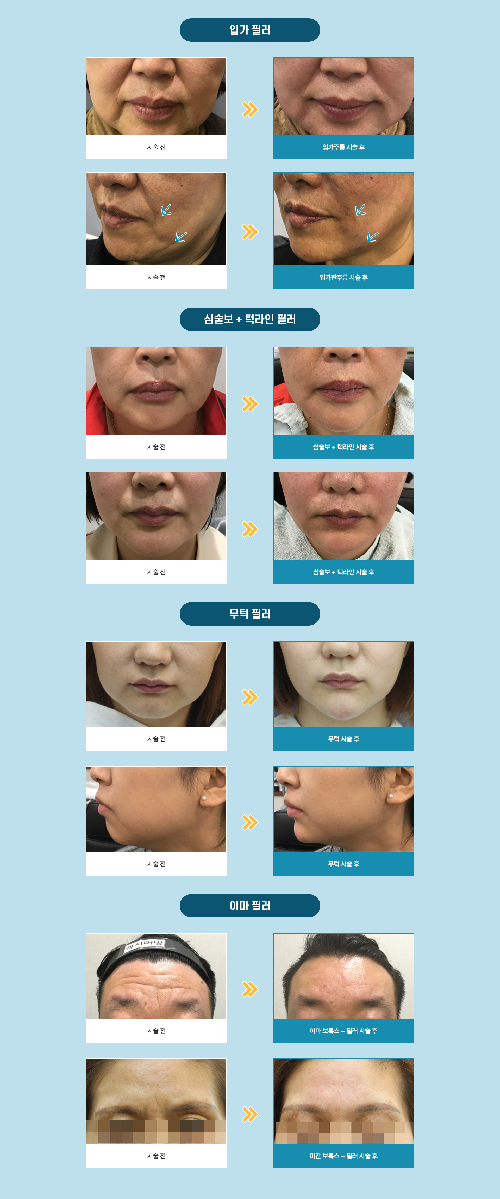 필러			치료방법