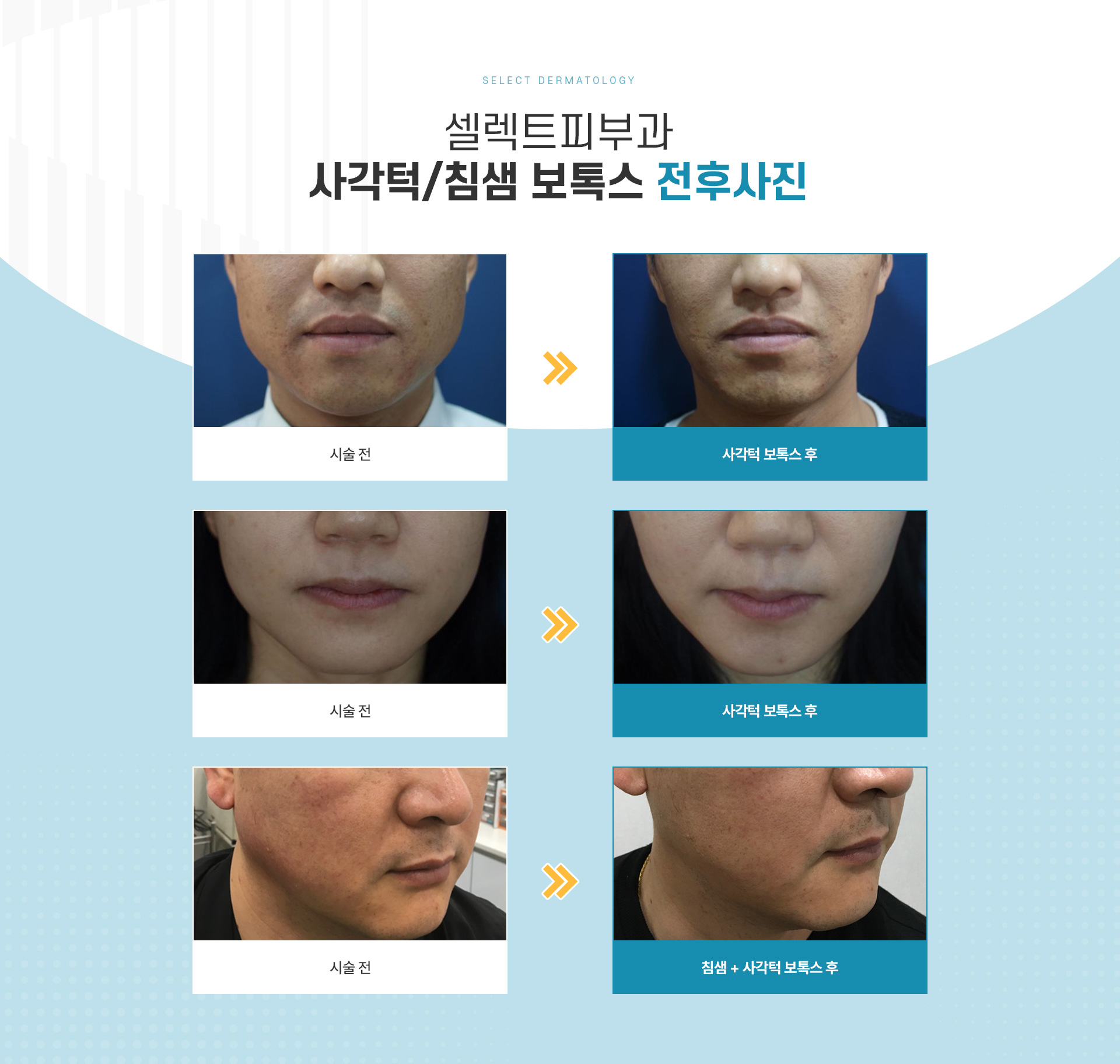 사각턱보톡스 전후사진