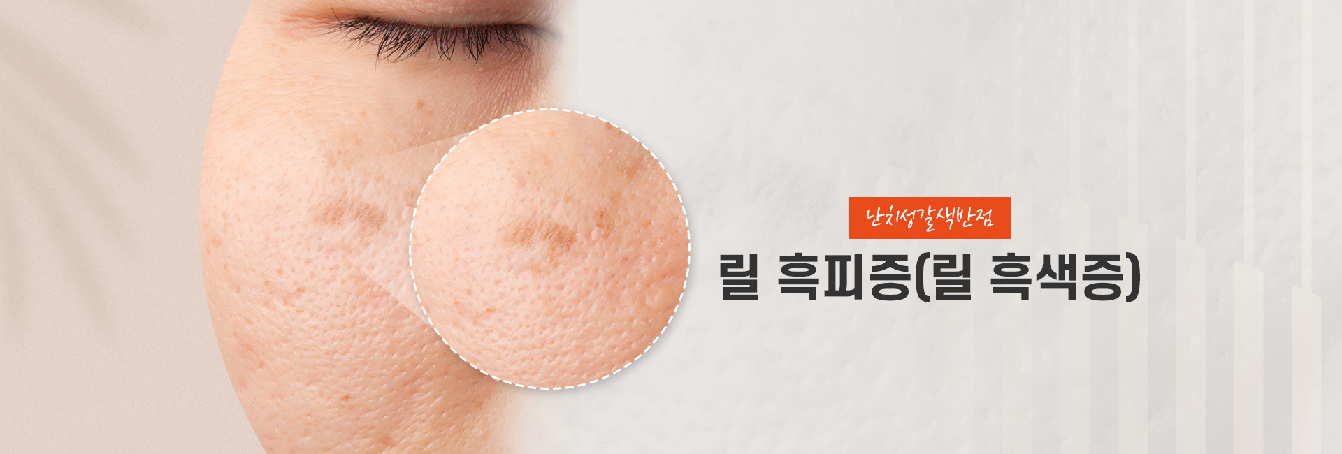 릴흑피증 키비주얼