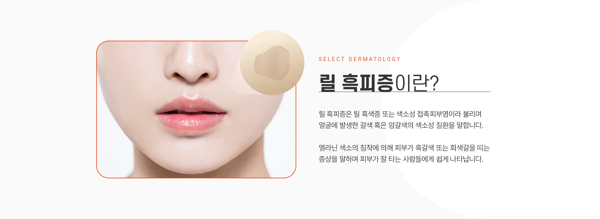 릴흑피증 가격안내