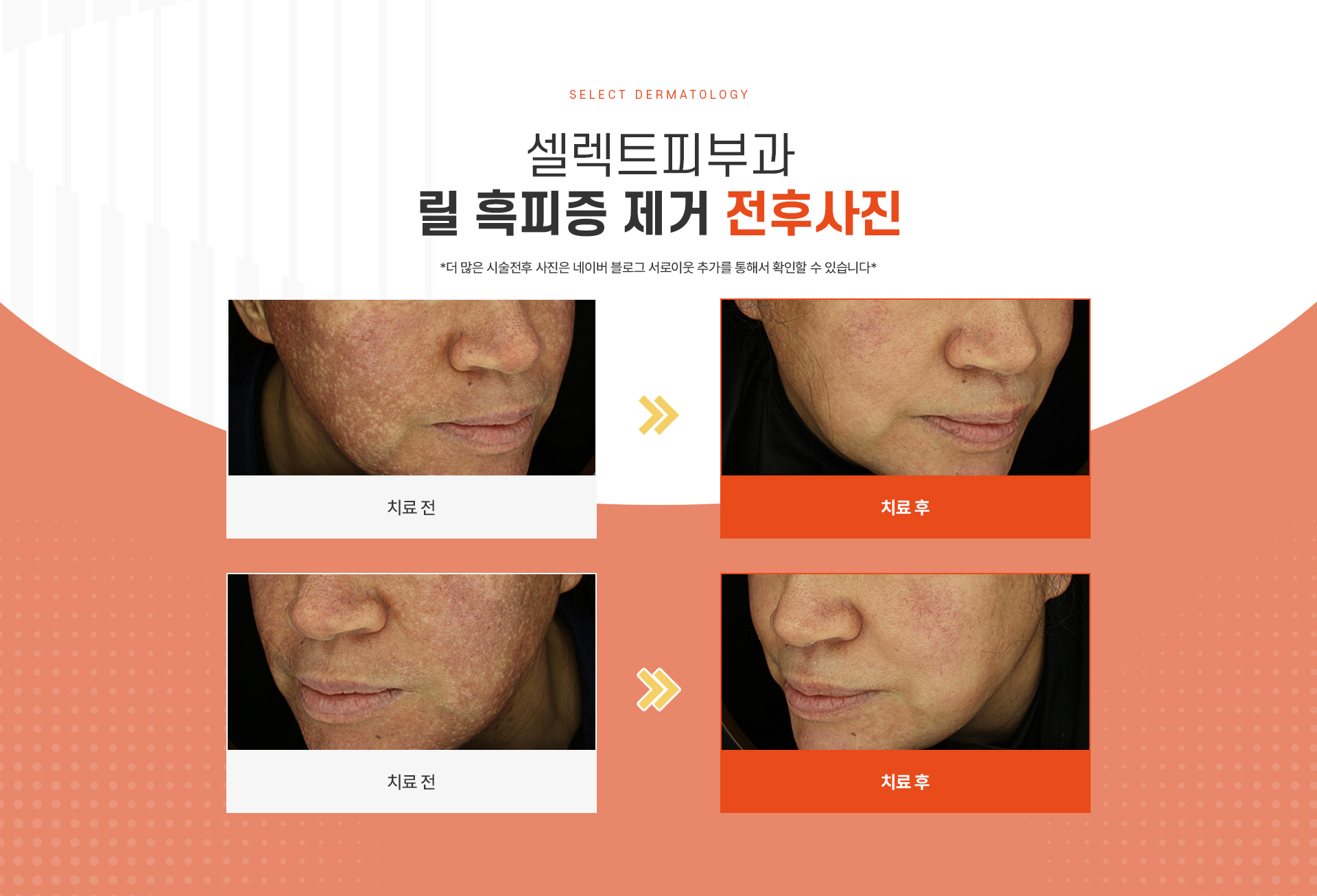릴흑피증 전후사진