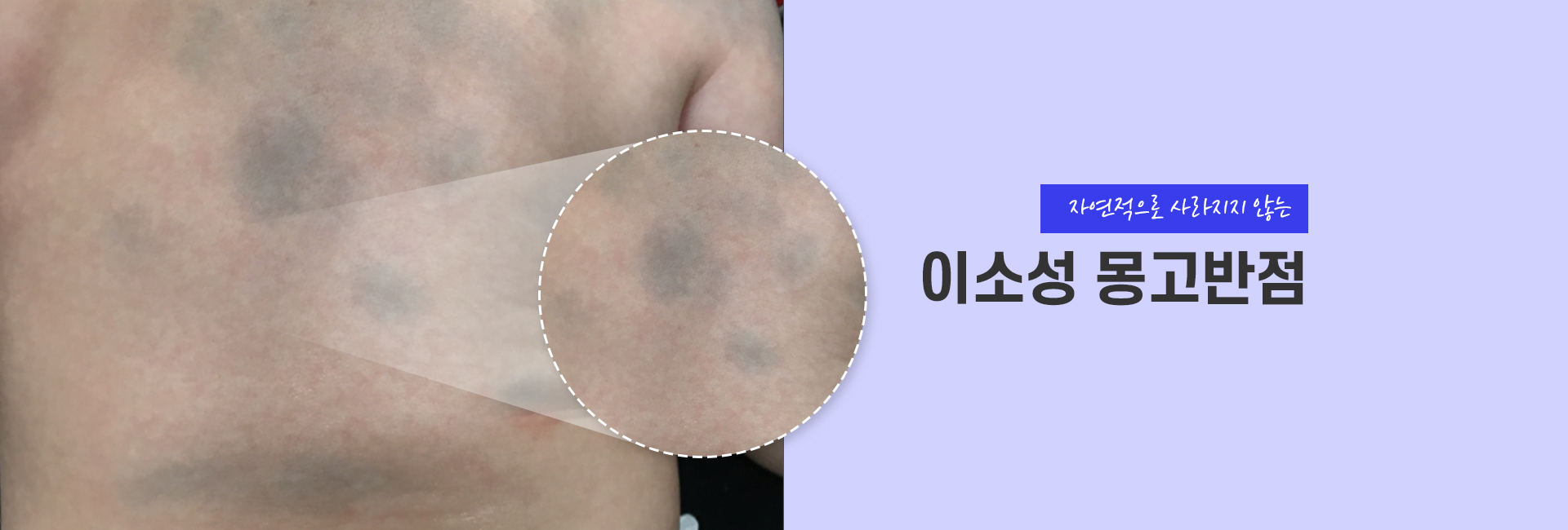 이소성몽고반점 키비주얼