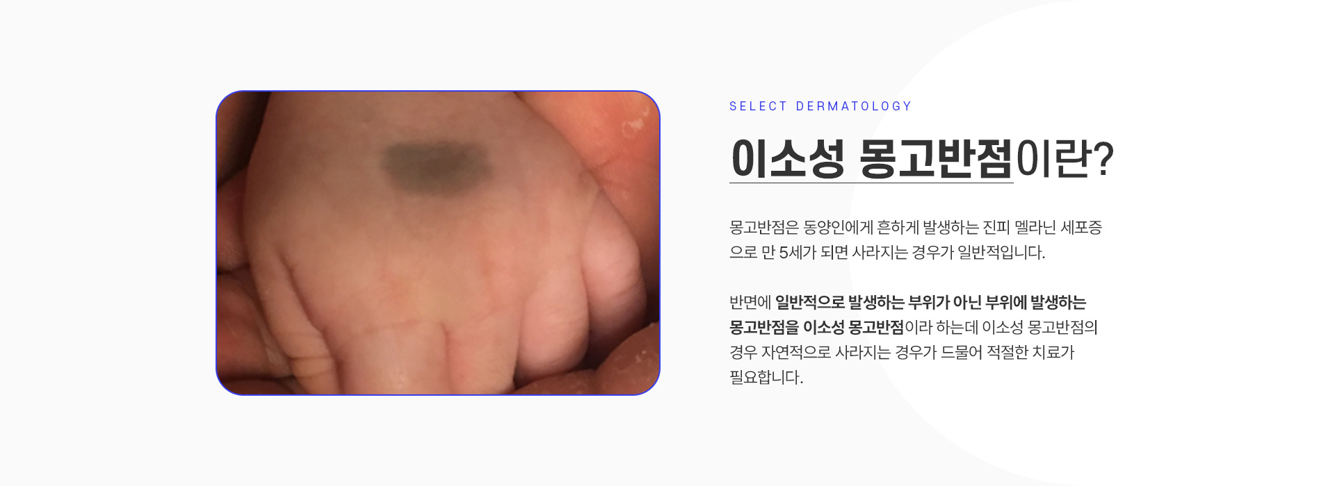 이소성몽고반점 가격안내
