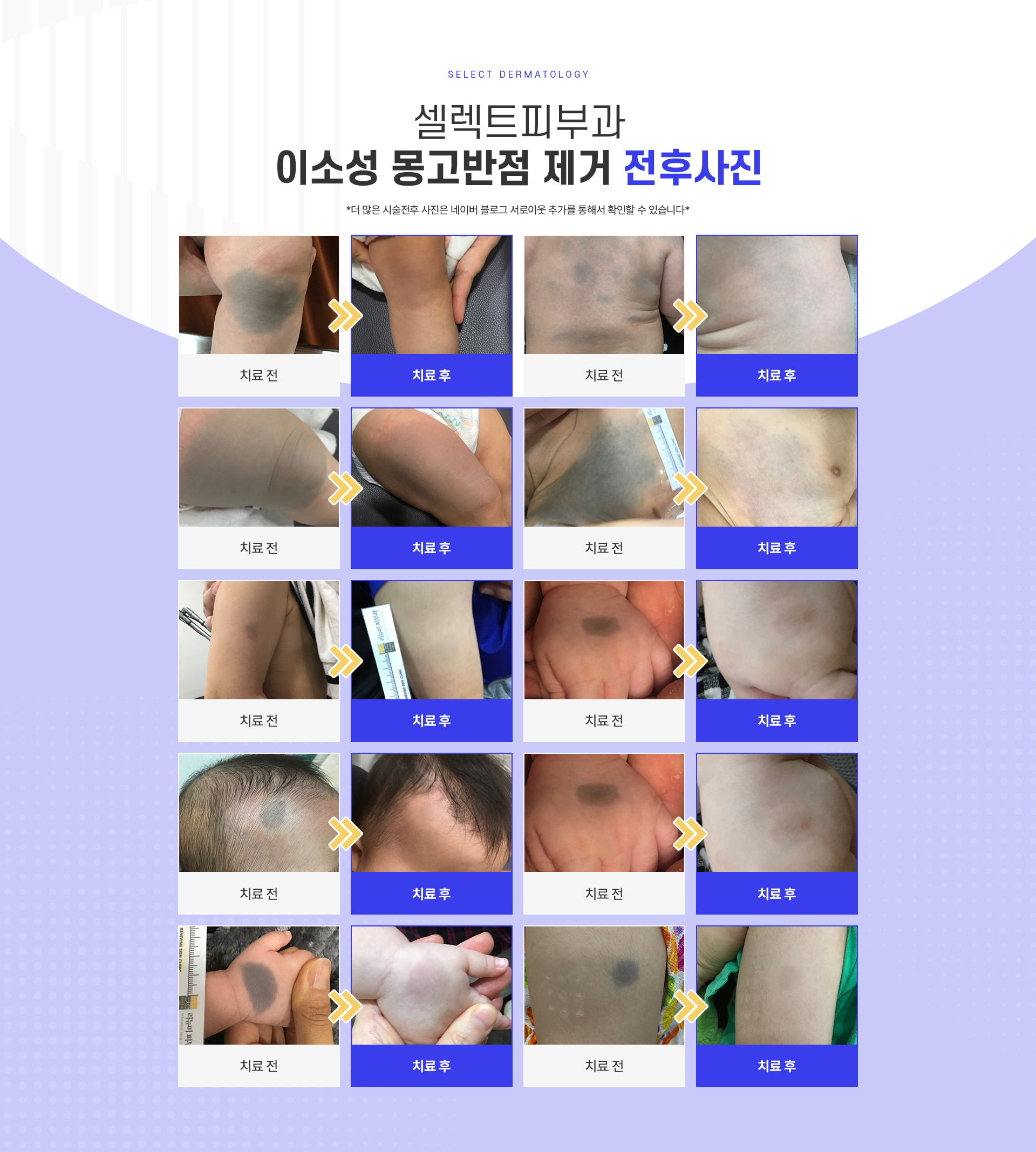 이소성몽고반점 치료방법