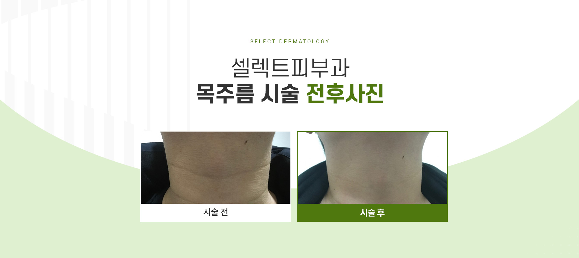목주름 전후사진