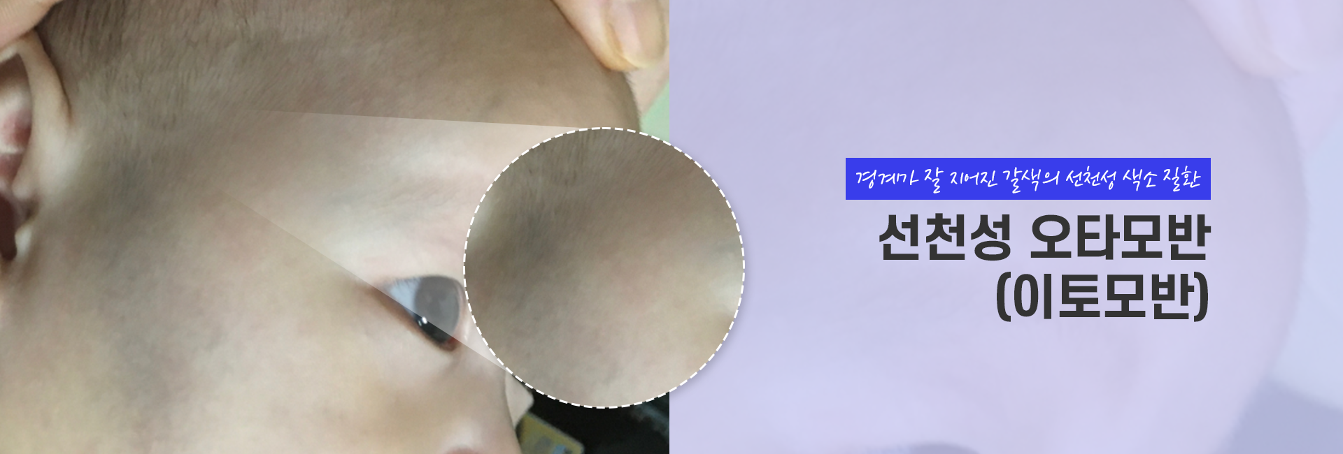선청성오타모반 키비주얼