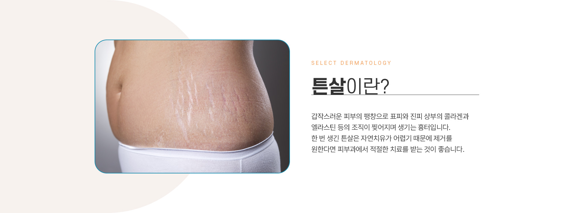 튼살 전후사진