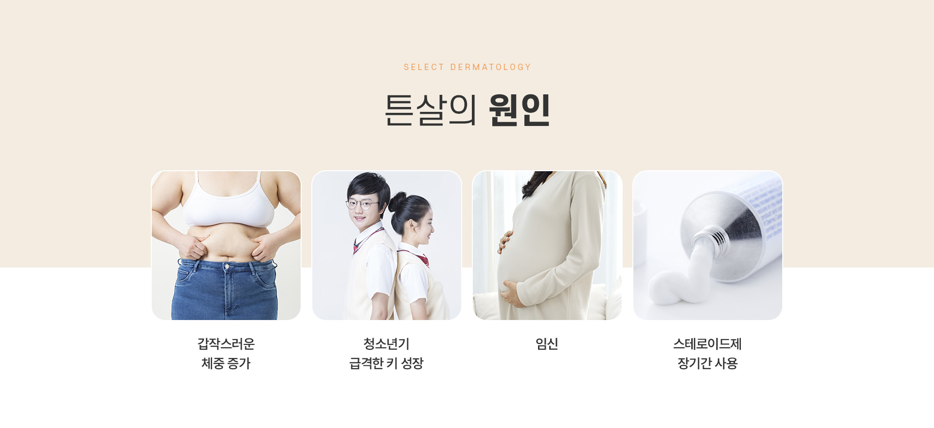 튼살 치료방법
