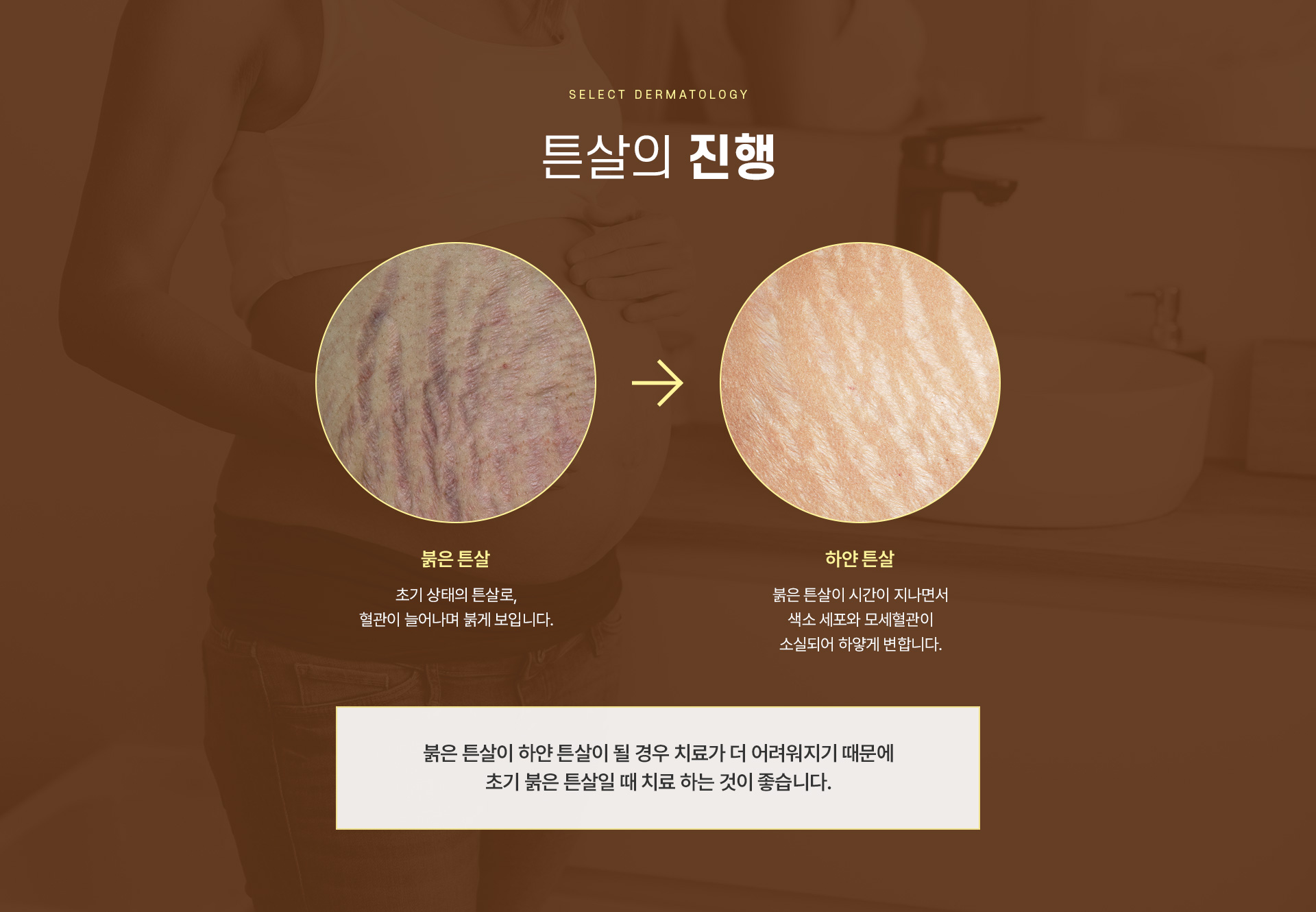 튼살 치료방법