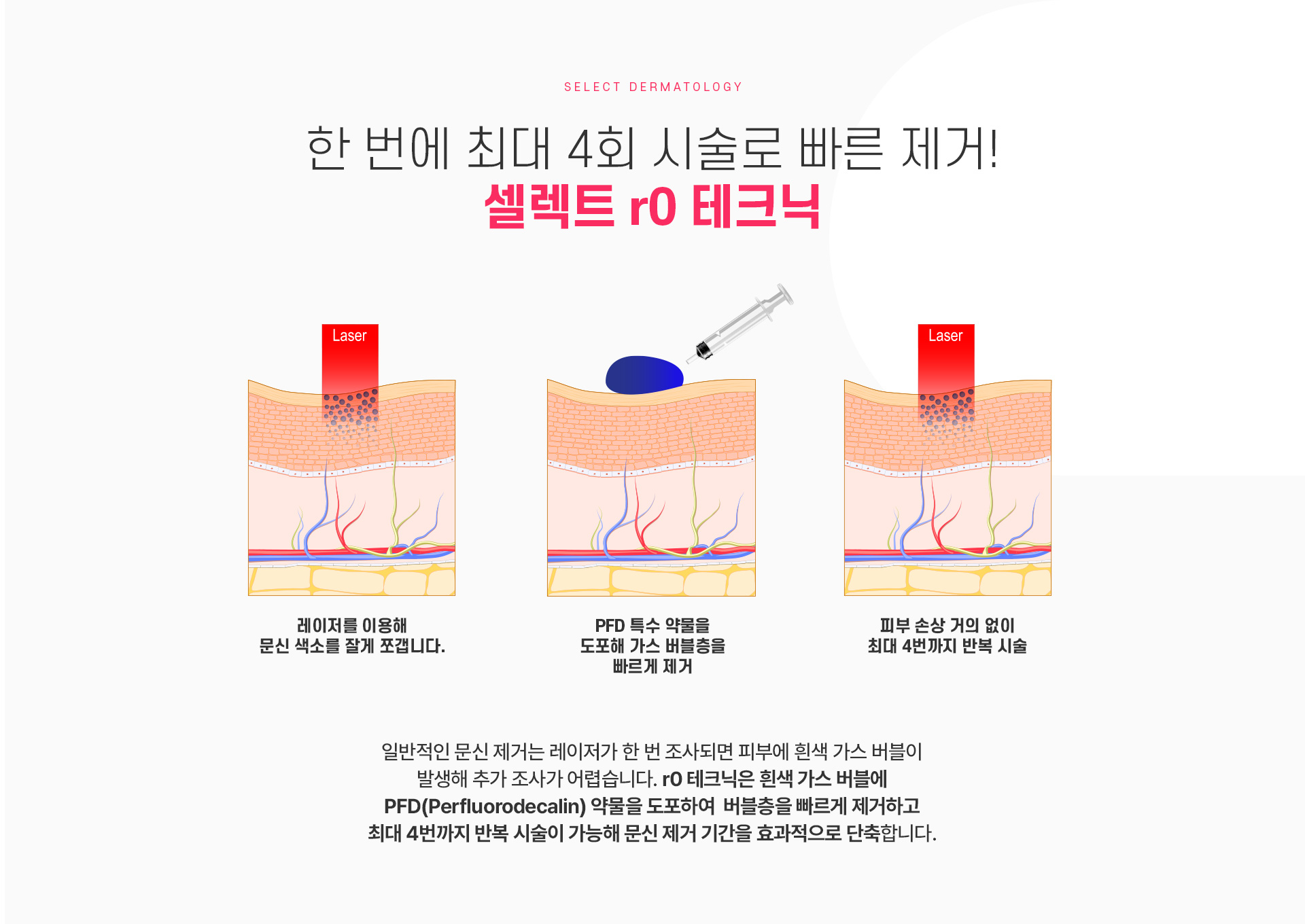 문신제거 가격안내