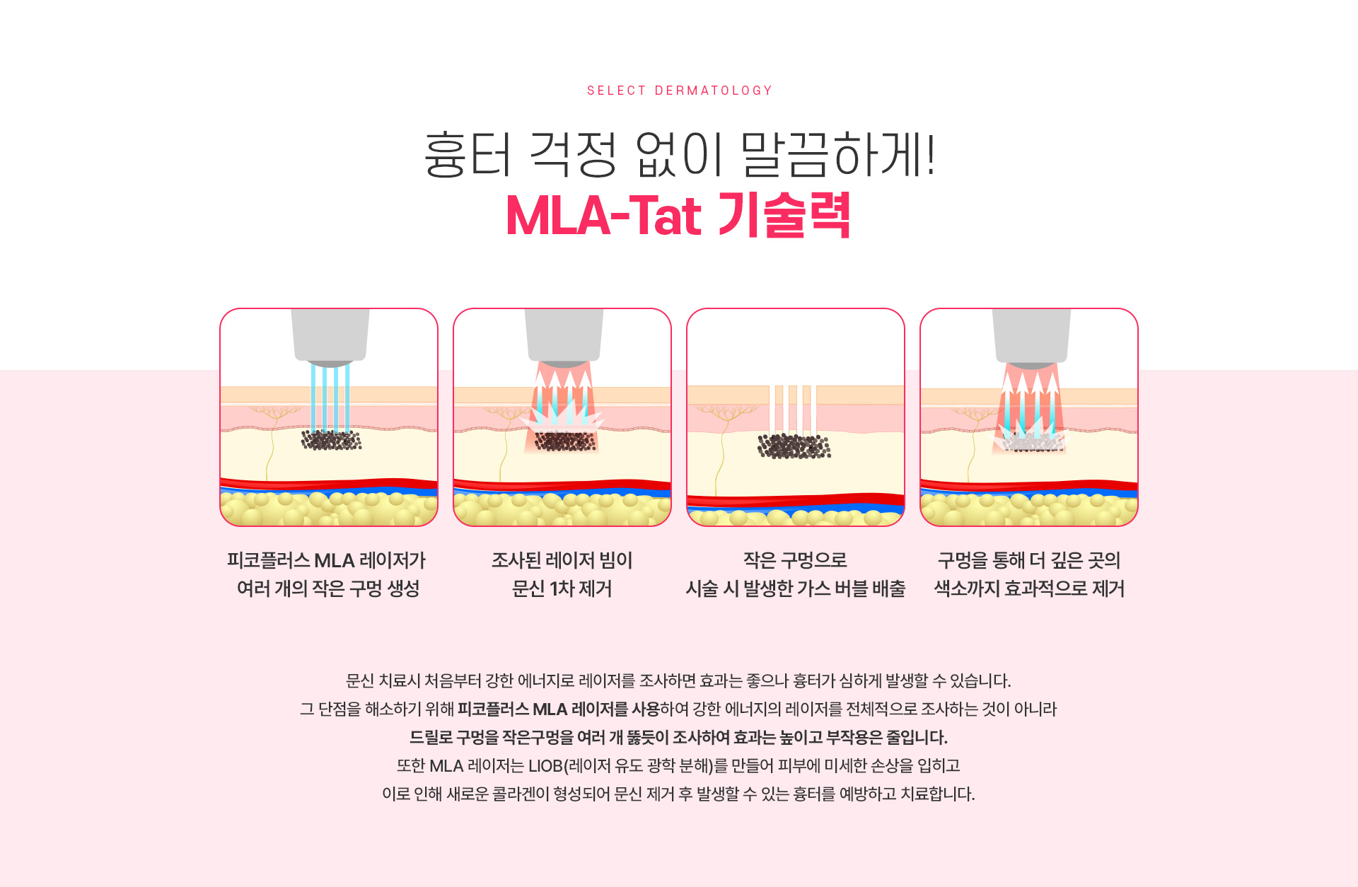문신제거 치료방법