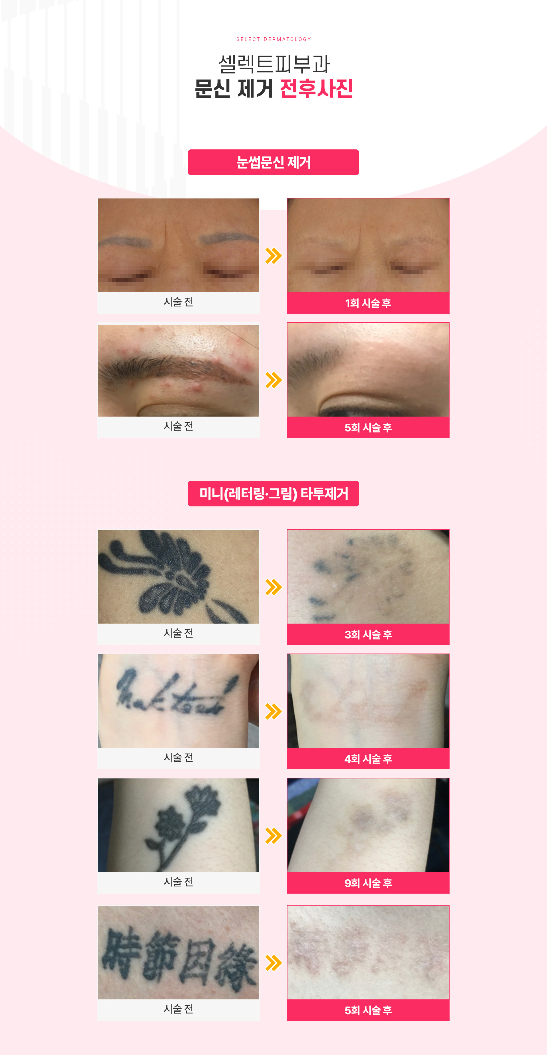문신제거 전후사진