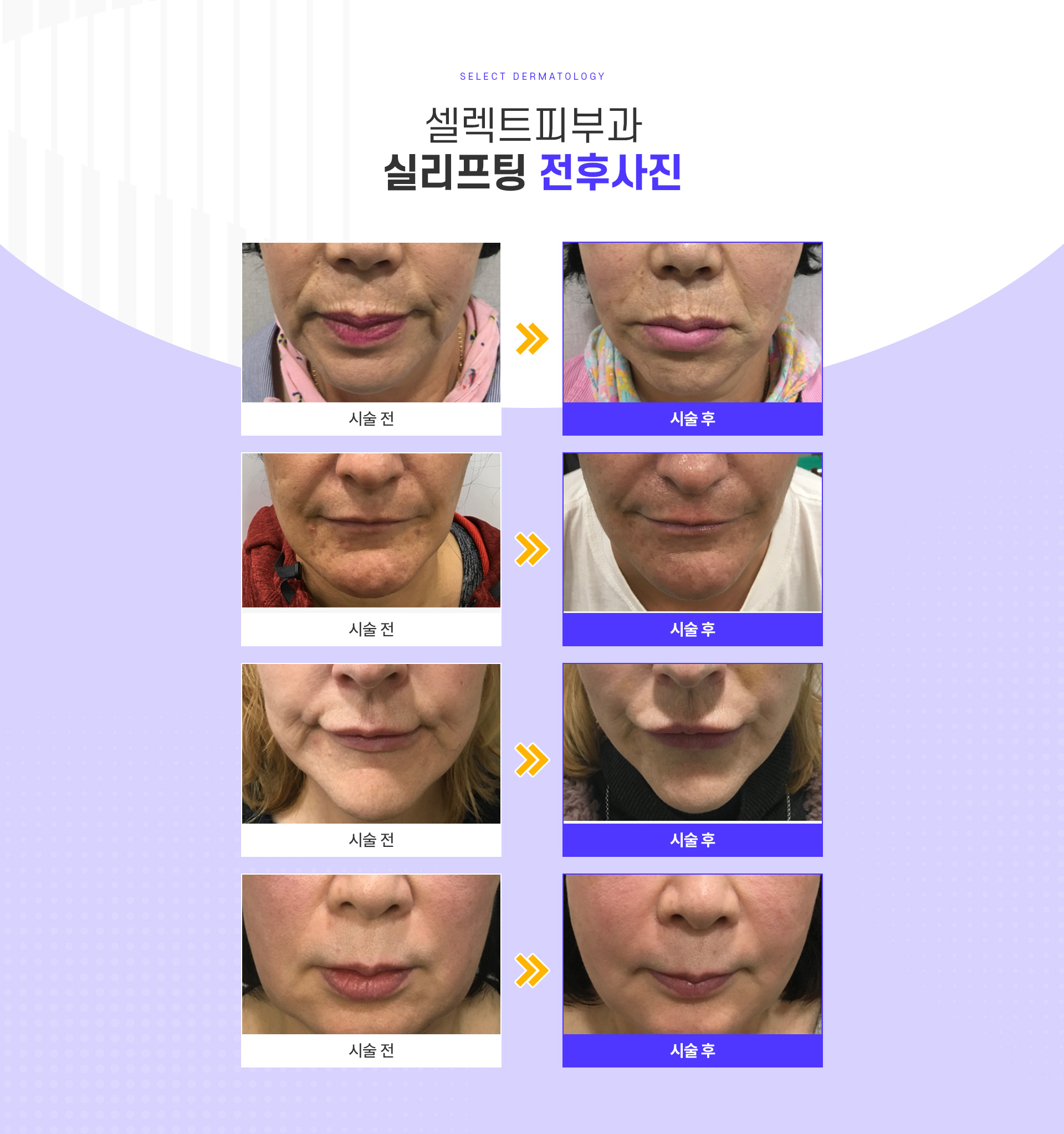 실리프팅 전후사진
