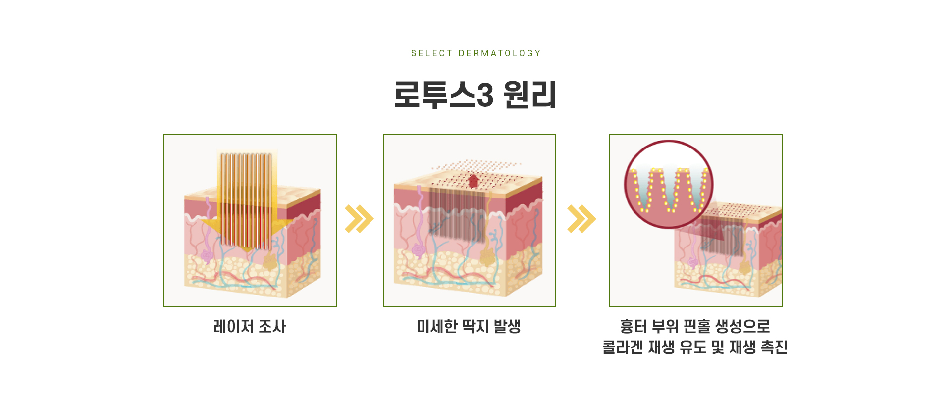 잔주름피부결 치료방법