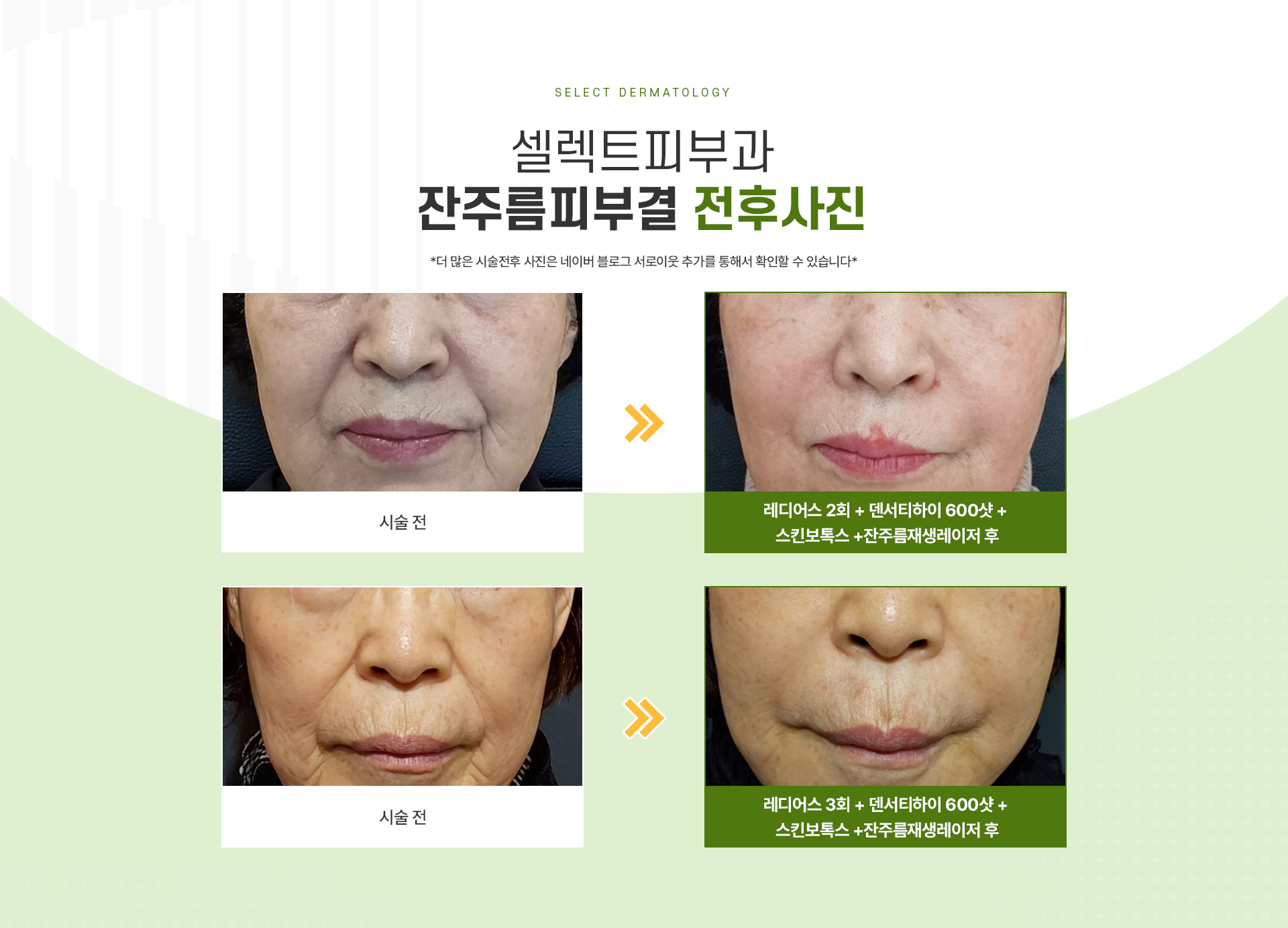 잔주름피부결 전후사진