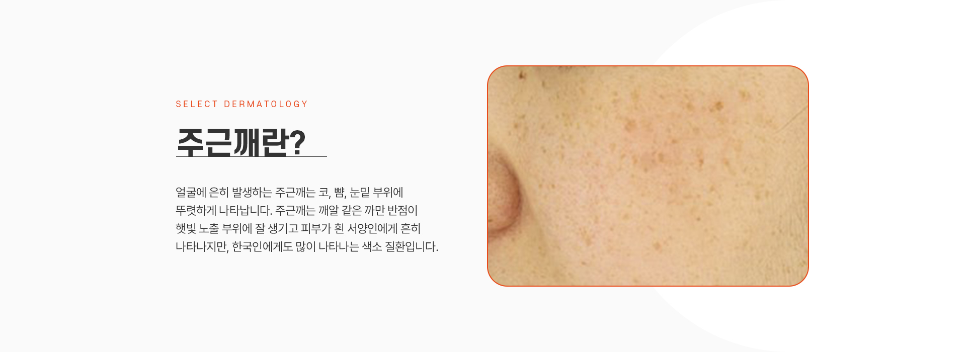 주근깨 소개