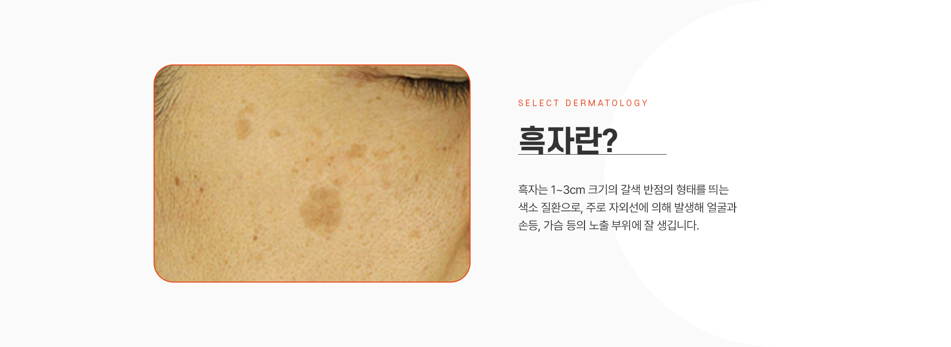 주근깨 종류