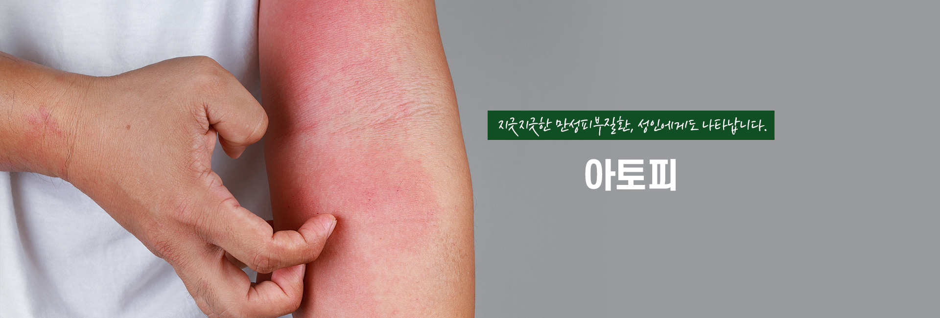 아토피 키비주얼