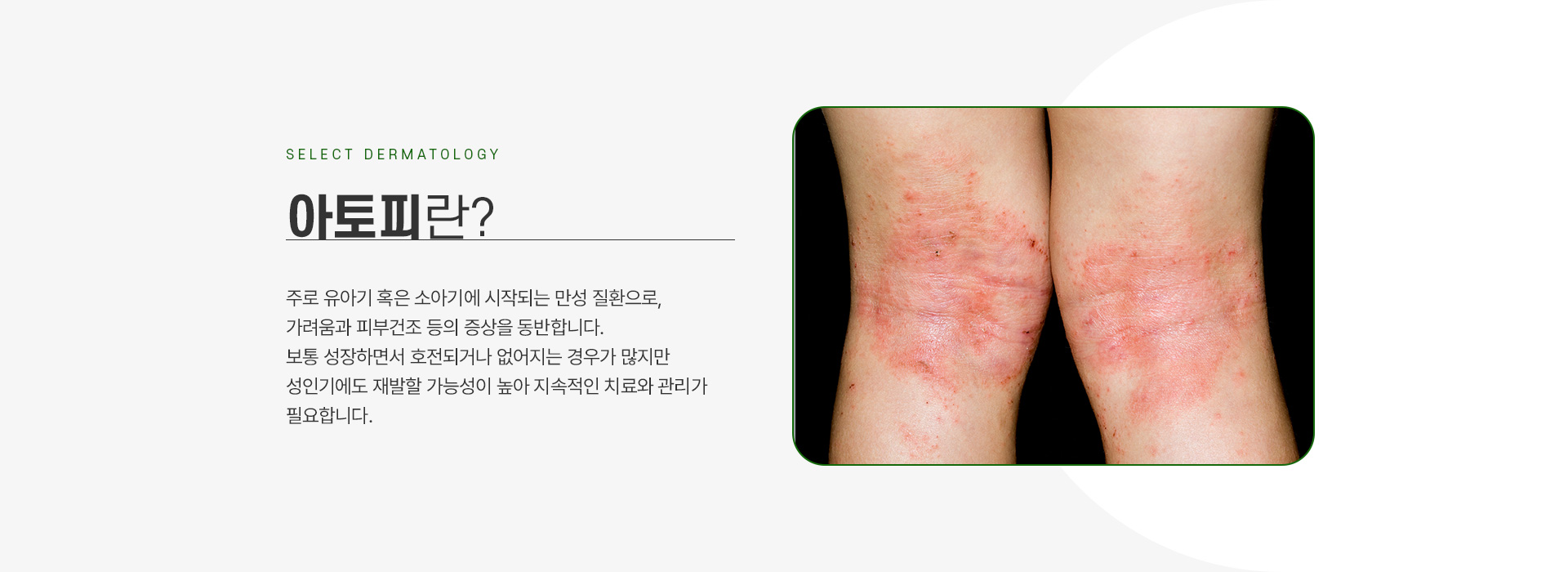 아토피 주의