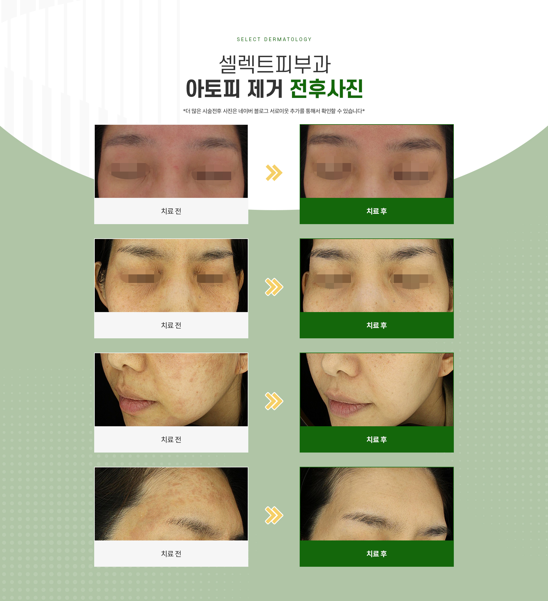 아토피 주의